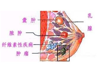 女性患有乳腺炎会导致什么后果